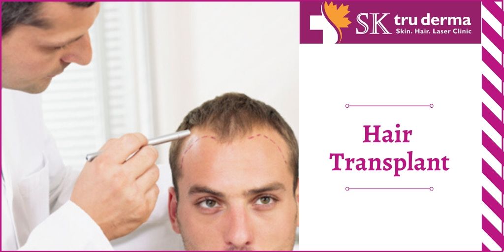 Hair Transplant |  Best Hair Loss Treatment In Bangalore

