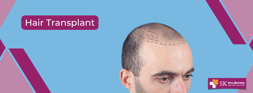 Hair Transplantation in Bangalore | Sktruderma